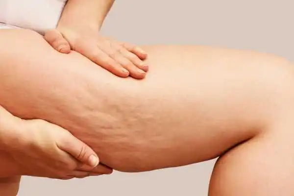 Image of woman showing leg with cellulite Royal Leamington Spa