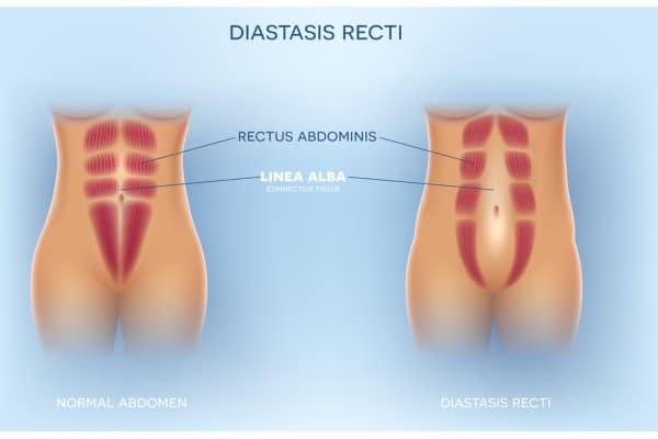 What Non-Surgical Options Are Available for Diastasis Recti Royal Leamington Spa?