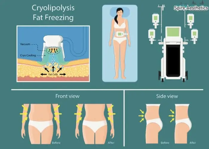Fat freezing treatment Royal Leamington Spa benefits for competitions to remove stubborn fat deposits.