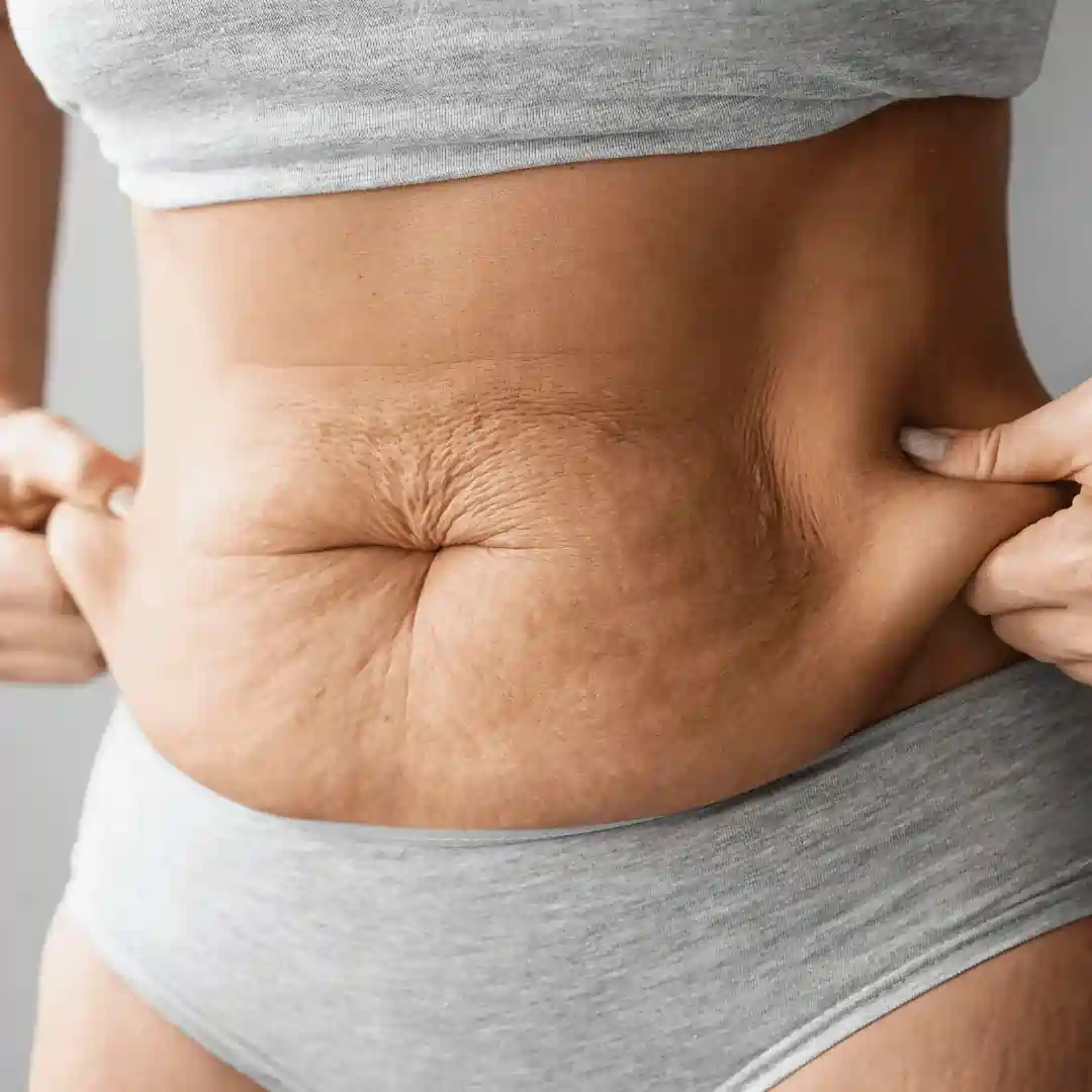 Is It Normal to Have Loose Skin After Pregnancy Royal Leamington Spa?