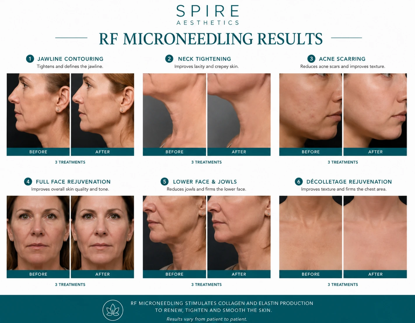 RF Microneedling Skin tightening Royal Leamington Spa results