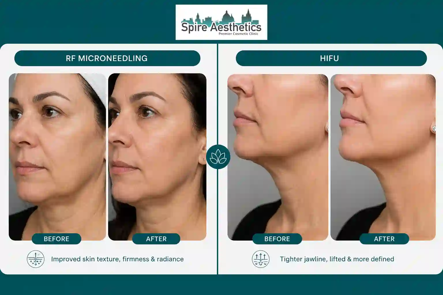 Can RF Microneedling and HIFU Be Combined Royal Leamington Spa?
