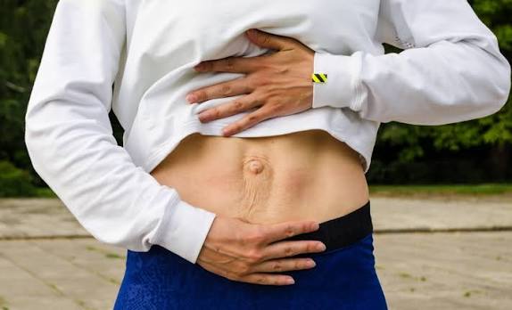 When Could Diastasis Recti Be the Missing Piece of the Puzzle Royal Leamington Spa?