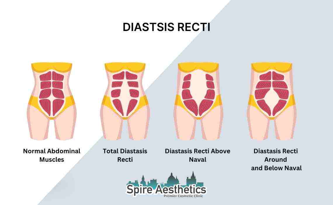 Is Non-Surgical Diastasis Recti Treatment Right for You? Common Concerns Answered Royal Leamington Spa